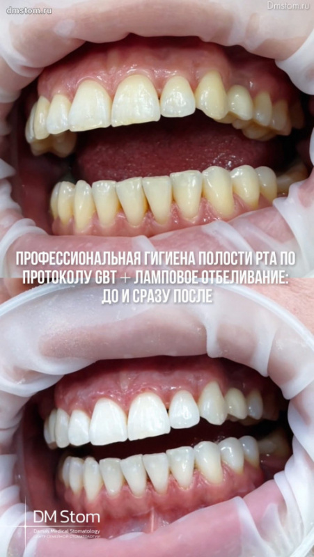 Профессиональная гигиена полости рта по протоколу GBT + ламповое профессиональное отбеливание: до и сразу после с фото и видео-результатом