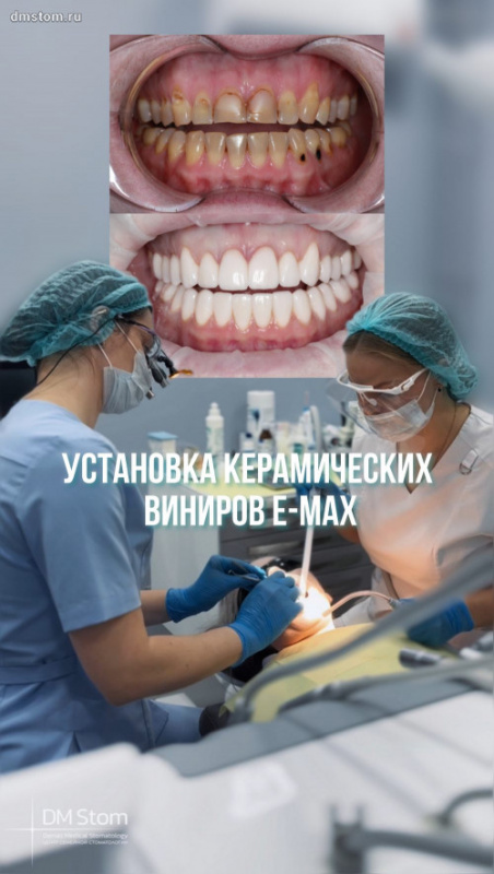 Установка керамических виниров Е-Max: 20 единиц в зоне улыбки (фото- и видео-результат)