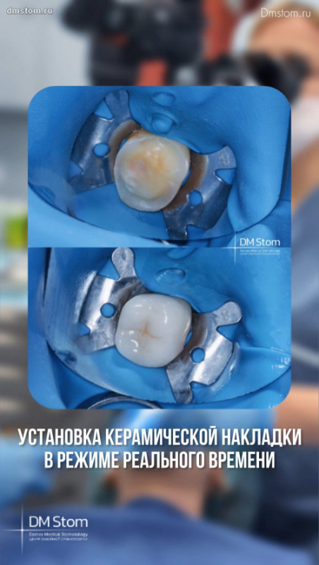 Установка керамической накладки в режиме реального времени за один визит на аппарате CEREC / ЦЕРЕК