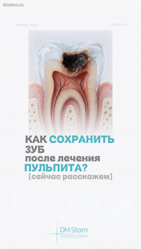 Как сохранить зуб после лечения пульпита? Риски и рекомендации