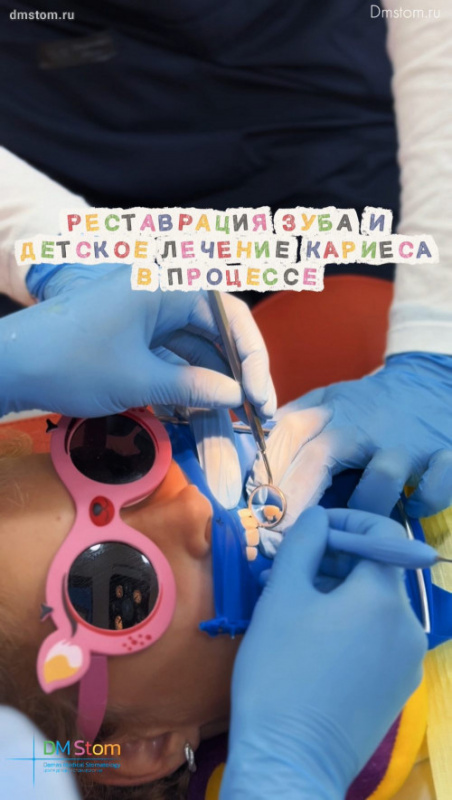 Детская реставрация скола зуба и лечение кариеса с фото-результатом