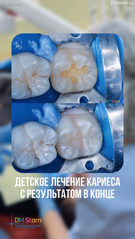 Детское лечение кариеса с фото и видео-результатом в конце