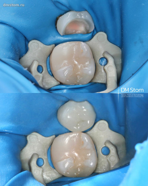 Установка керамической вкладки Cerec: до и сразу после. Керамика за один визит