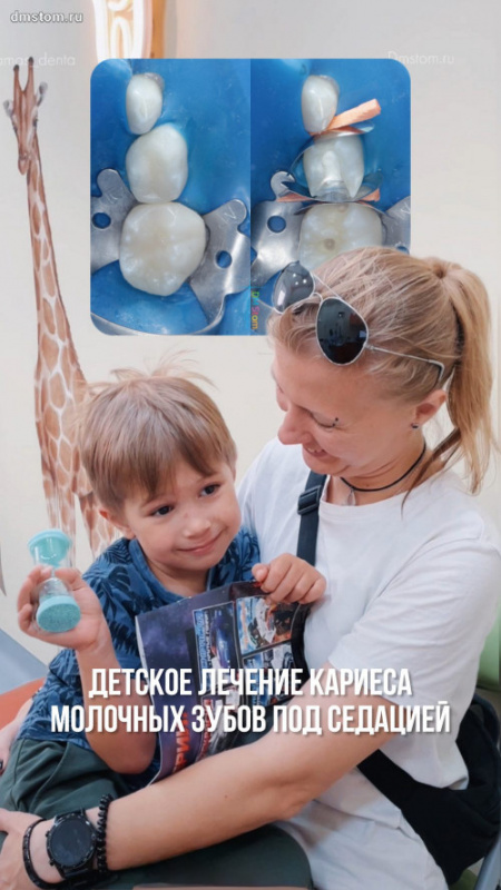 Детское лечение кариеса молочных зубов под седацией. Кириллу 5 лет